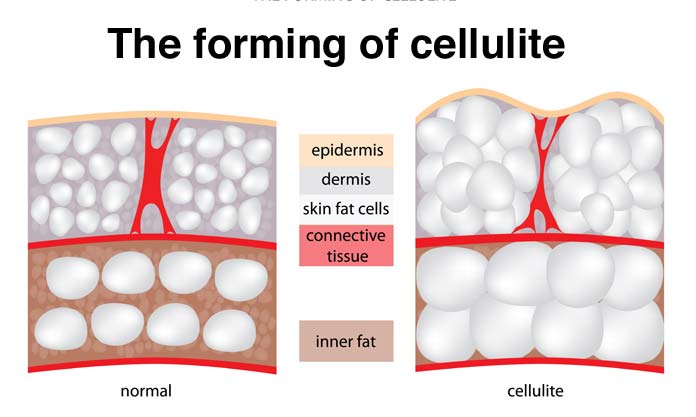 149465-cellulite-forming